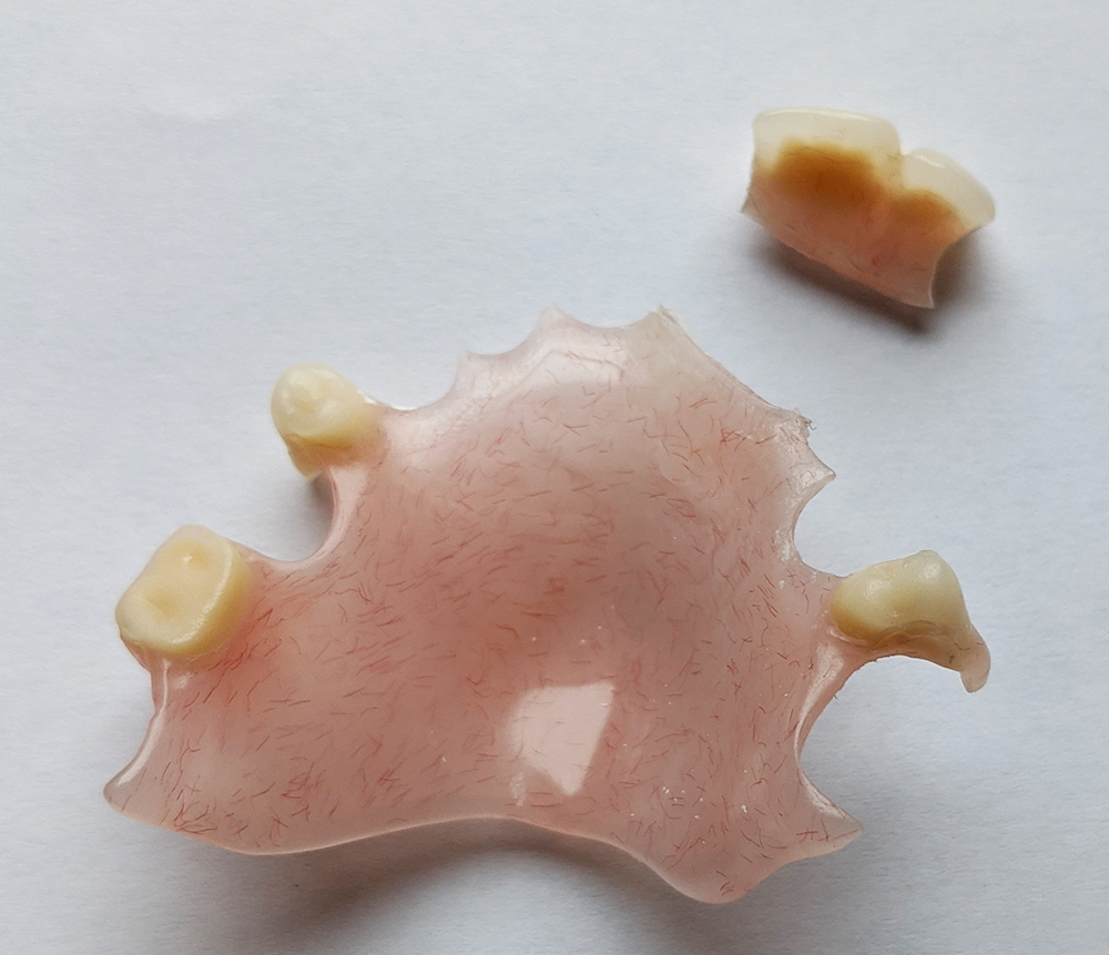Denture - before