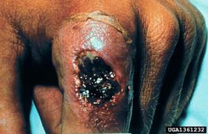 Brown Recluse Spider Bite