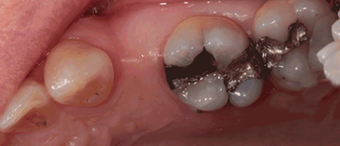 Dental Bridges Milford Dentists
