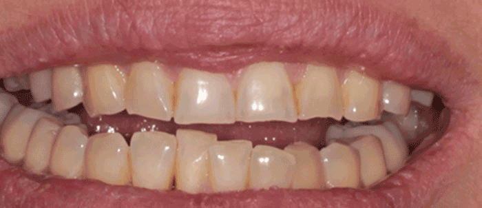 Veneer