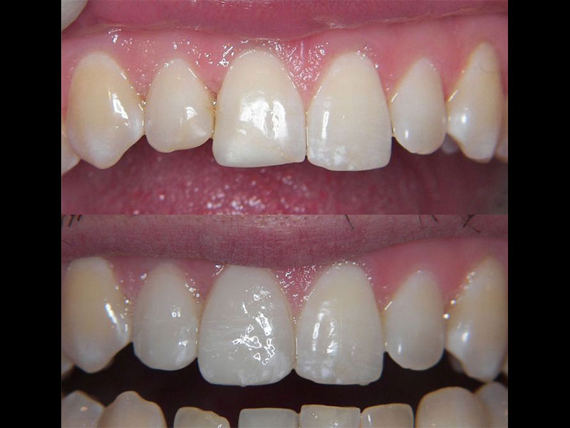Sameday Emax Porcelain veneers Andrea Clarke BDS