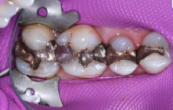 Mercury Amalgam Removal