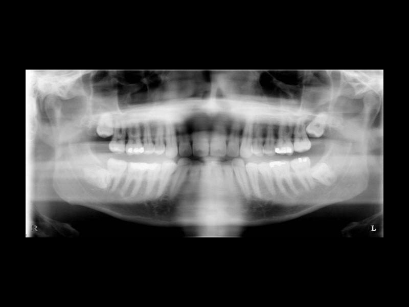 Panorex or OPG x-ray showing impacted lower wisdom teeth