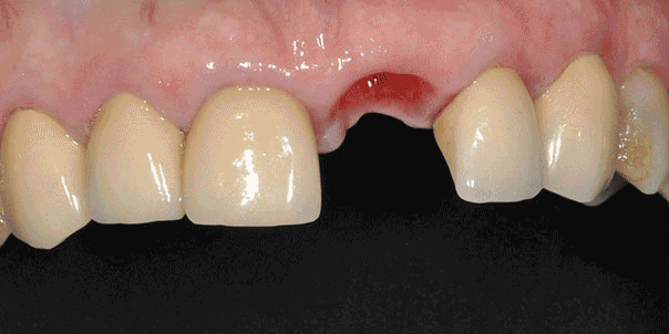 Dental Implant work by Tristan Baker