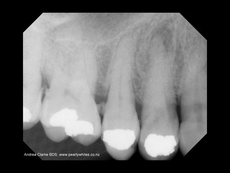 Premolar root filling before
