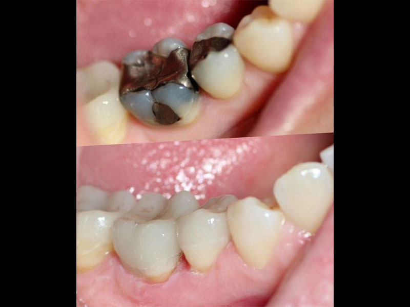 Mercury Amalgam Fillings replaced with Emax Same Day Overlay Crowns Andrea Clarke BDS
