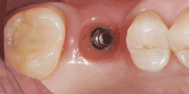 Dental Implant work by Tristan Baker
