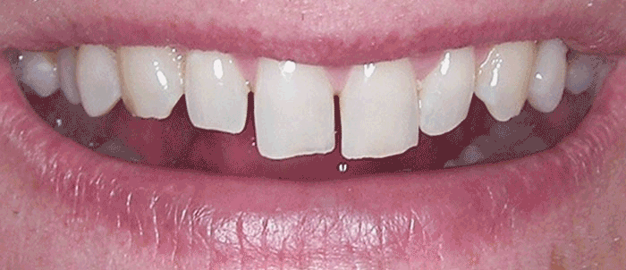 4 Emax Porcelain Veneers & Composite Resin Fillings Andrea Clarke BDS