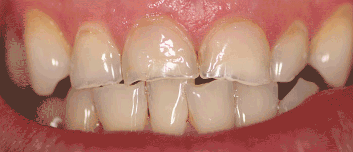 Veneer