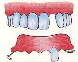 Budget Acrylic Denture Milford Dentists