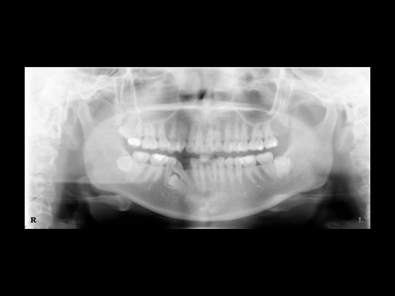 Panorex or OPG x-ray showing impacted lower wisdom teeth & an impacted lower premolar tooth that has tipped the eye tooth backwards