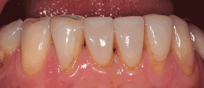 Veneer