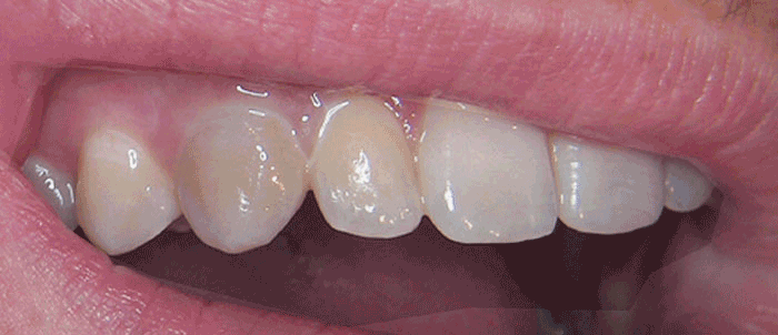Internal Tooth Lightening