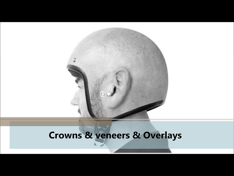 Crowns Veneers & Overlays