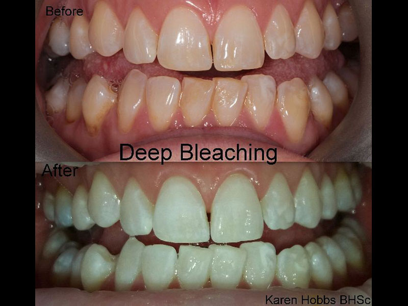 Deep Bleaching