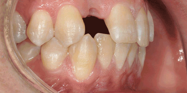 Dental Implant work by Tristan Baker