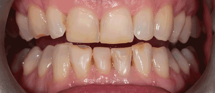 Milford Dentists Tooth Veneers