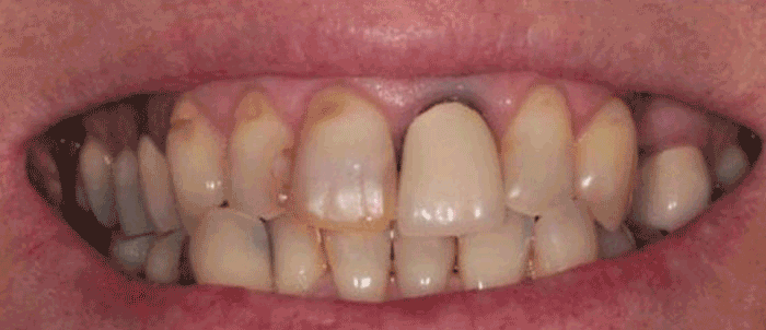 1 emax crown, 3 emax veneers & white fillings. Andrea Clarke BDS