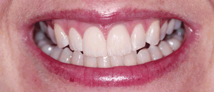 Same Day Veneer