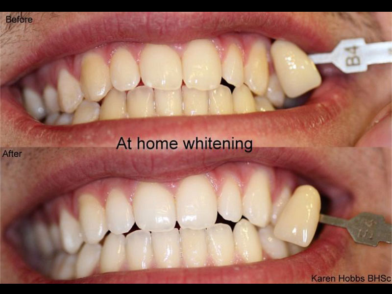 At Home Whitening