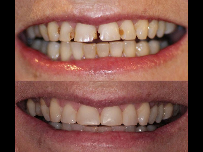Multiple White fillings Andrea Clarke BDS