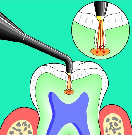Milford Dentists Diagmodent Decay Assement
