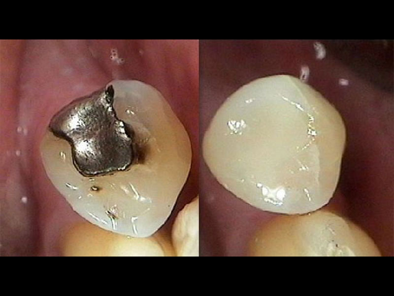Mercury Amalgam Filling replaced with White Composite Resin Filling Andrea Clarke BDS