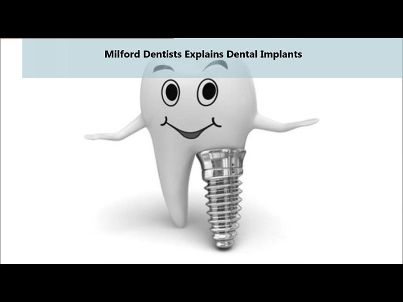 Dental Implants explained