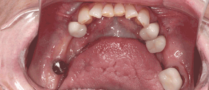 Denture