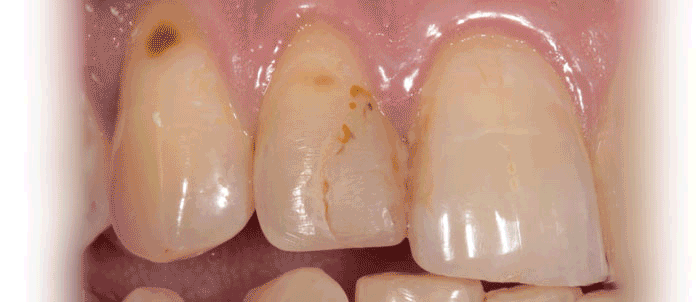 White Filling Replacement