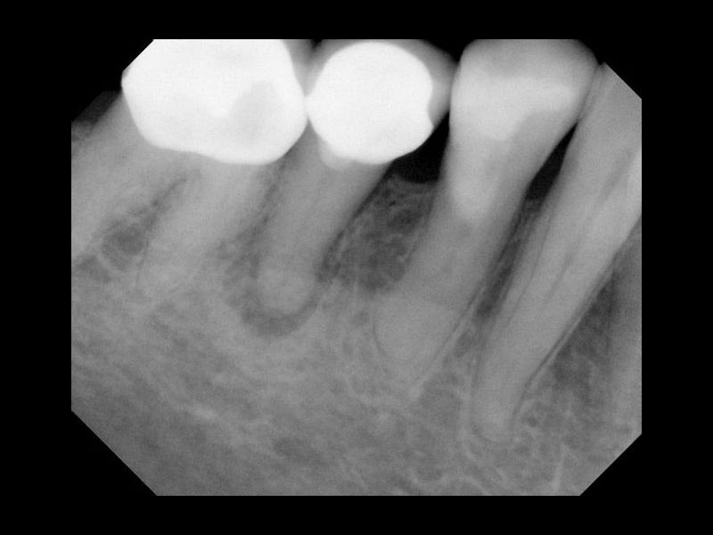 Premolar root filling before