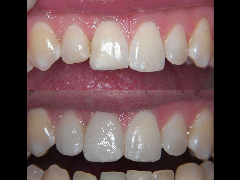 Same day E4D Emax cad cam veneers, two veneers on lateral and central incisor: Before and After. Andrea Clarke BDS
