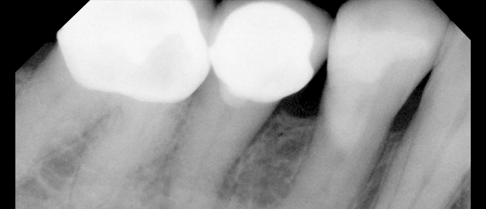 X-Ray Root Filling