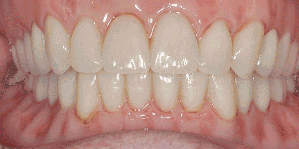 Dental Implant work by Tristan Baker