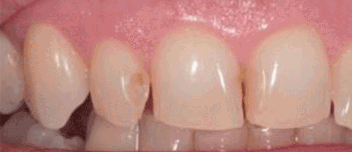 White Composite filling to repair a damaged tooth Andrea Clarke BDS