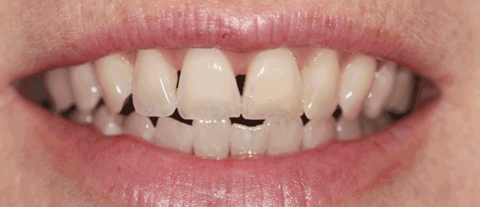 Veneer