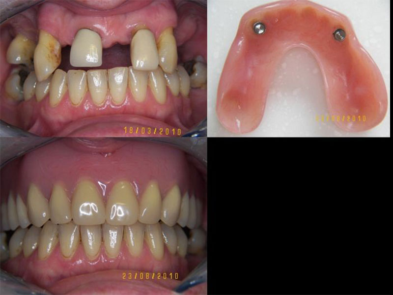 Overlay Full Upper Denture with Precision Attachments Tristan Barker BDS