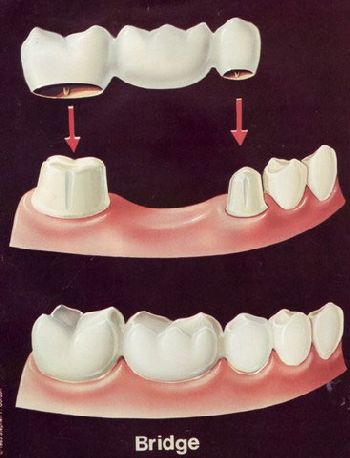 Dental Bridges