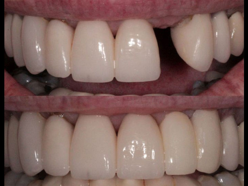 2 Unit Cantilever Emax Bridge replacing lateral incisor. Andrea Clarke BDS