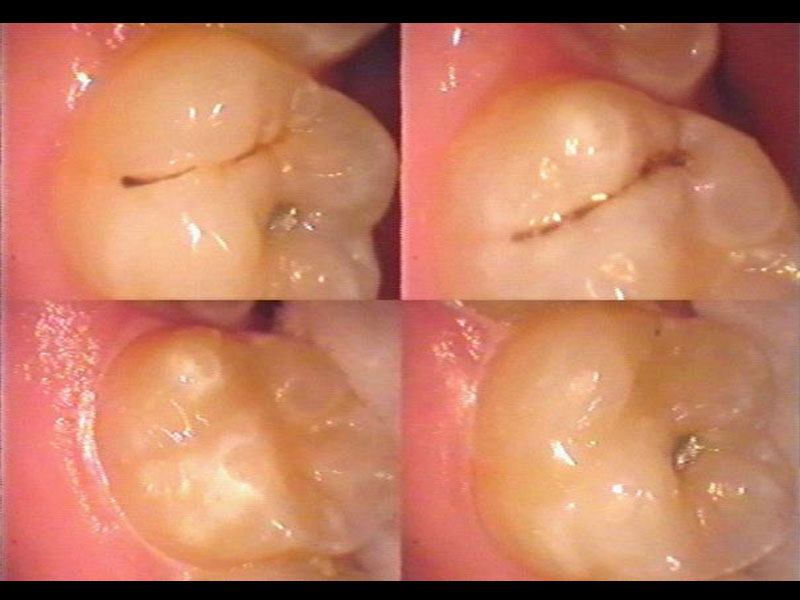 Before Air Abrasion & then after sealant restorations completed. Andrea Clarke BDS