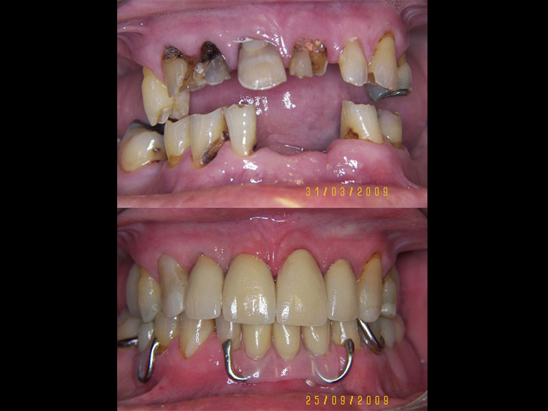 Full Mouth Rehabilitation with lower Chrome Cobalt Partial Denture & upper porcelain crowns Tristan Barker BDS