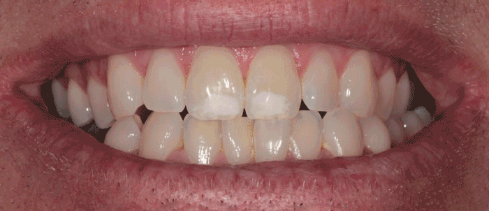 Whitening