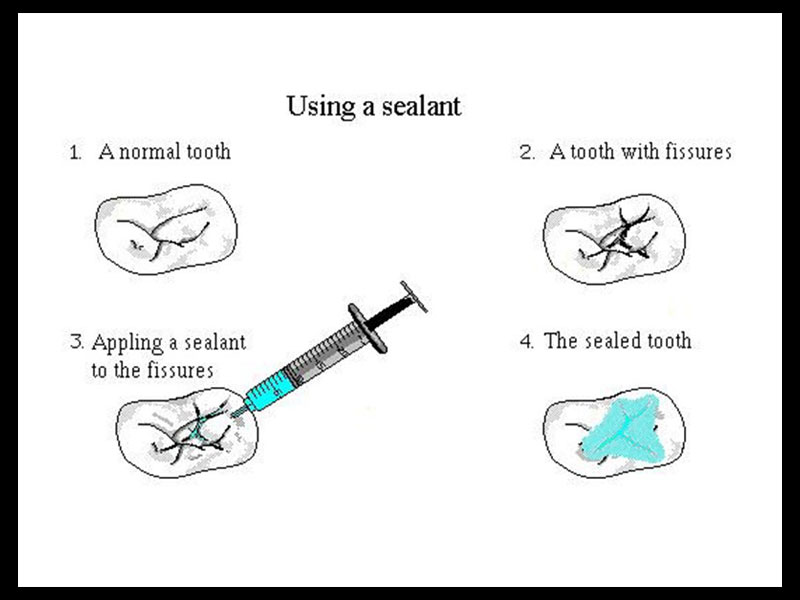 After the pits and fissures have been thoroughly cleaned & any decay gently removed with Air Abrasion these areas are sealed with a permanent flowable white composite resin that is set hard by shining a blue dental light onto the material - Done