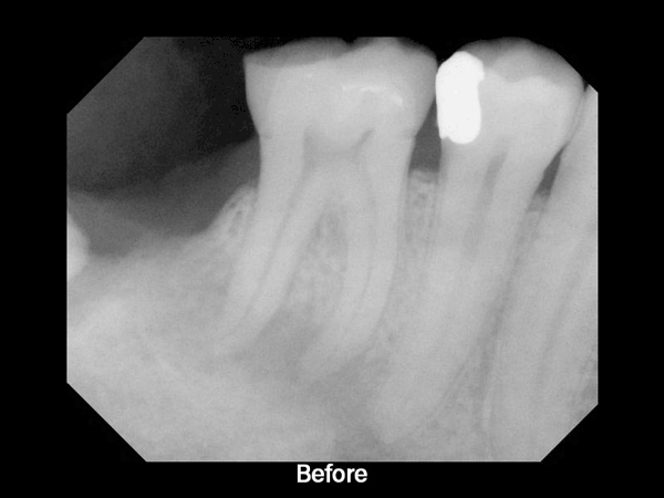 Milford Dentist Root Filling