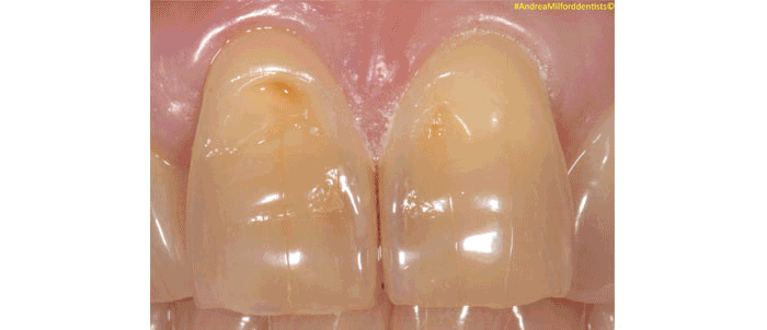 White Filling Replacment