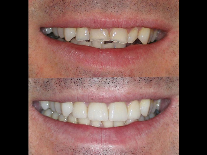 4 Emax Overlay Crowns to repair acid eroded & chipped incisors Andrea Clarke BDS
