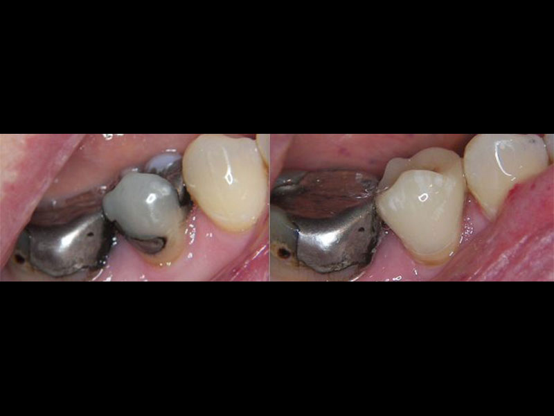 Mercury Amalgam Filling replaced with Emax Same Day Overlay Crown Andrea Clarke BDS