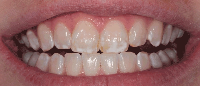 Whitening