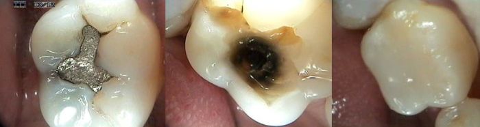 Mercury Amalgam Removal