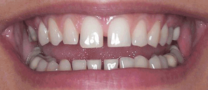 This lady did not like her small front teeth & the gaps. We worked very closely with my technician David De Wet at Oral Art to provide 7 emax press porcelain tooth veneers on her upper incisors & right eye tooth & the lower central incisors. We also lightened her teeth & used a lighter shade of porcelain to enhance the overall pleasing end result. Andrea Clarke BDS